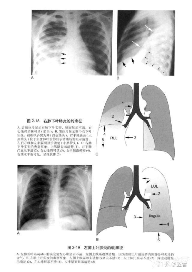 教科書上也很少見這麼經典的胸片附肺實變的輪廓徵圖