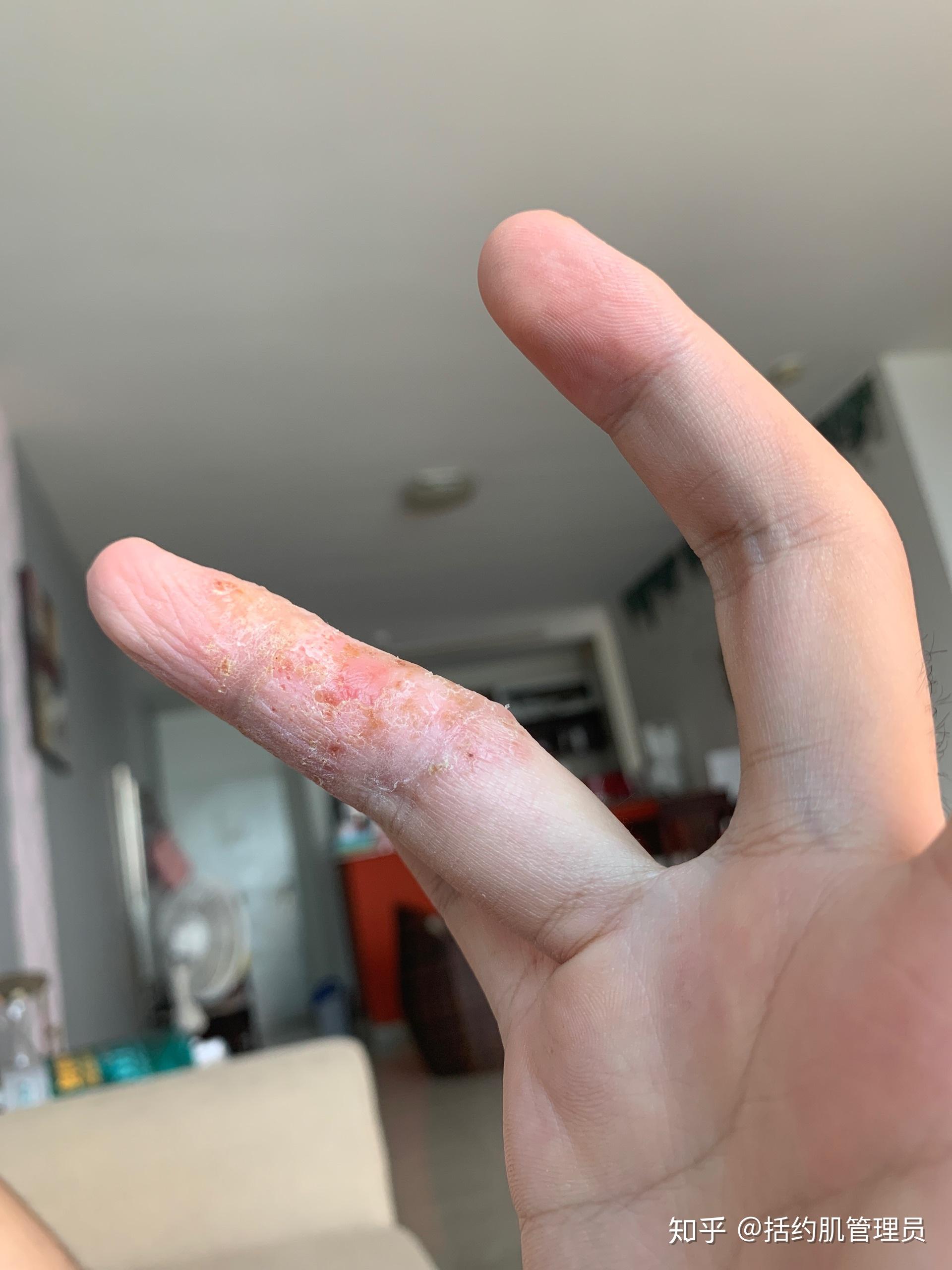 手上长很痒的水泡里面的水是什么水从哪来的