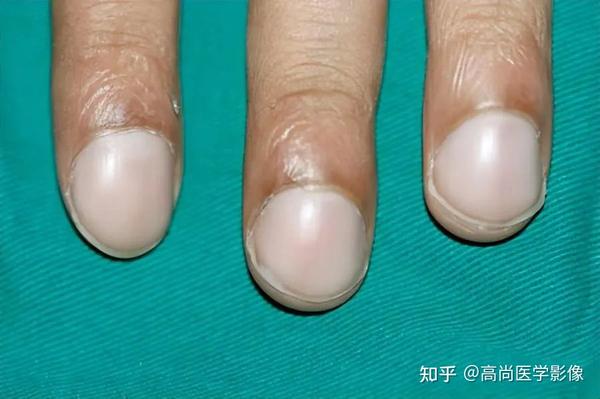 体内有癌，手指先知？提醒：手指出现这些症状，可能是疾病的信号 - 知乎