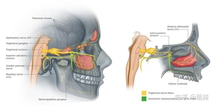 窦性偏头痛Sinus Migraine:容易误诊为鼻窦炎的偏头痛类型 - 知乎
