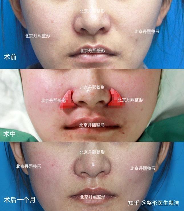 鼻基底填充修复术之假体厚度不足类修复
