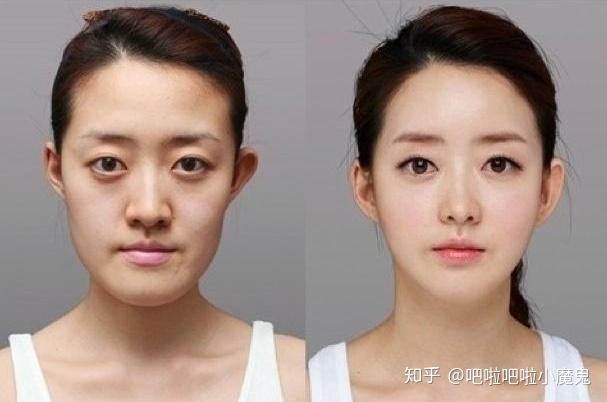 磨骨颏侧截骨国字脸的福音