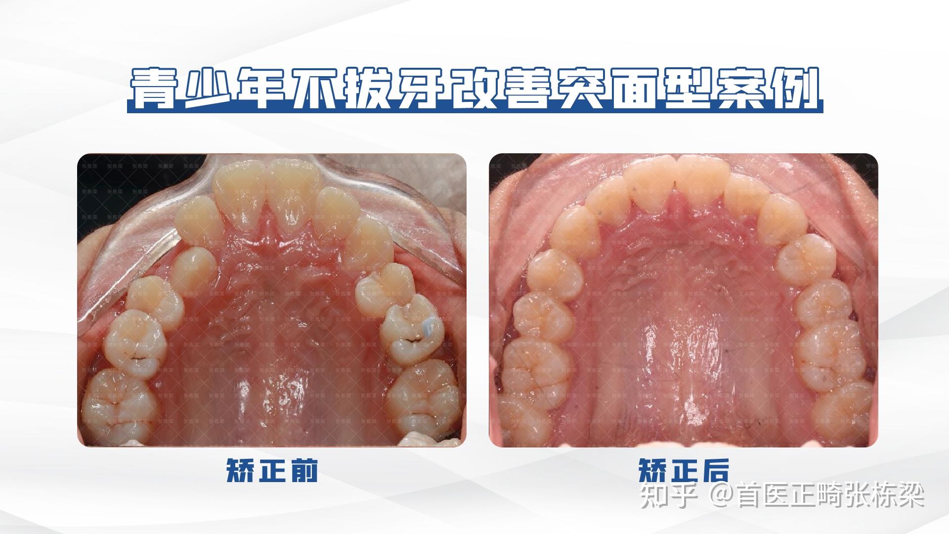 嘴突,开唇露齿牙齿正畸案例