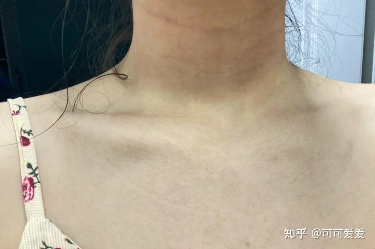 那些去颈纹的人，都后悔了-健康教育-清华大学附属北京清华长庚医院医疗美容科