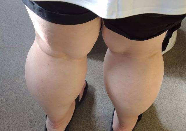 怎么才能使自己大腿更瘦一点 v2-5dc0c2ec914b7d70ce8b3ba20b2a6dbd_r.jpg