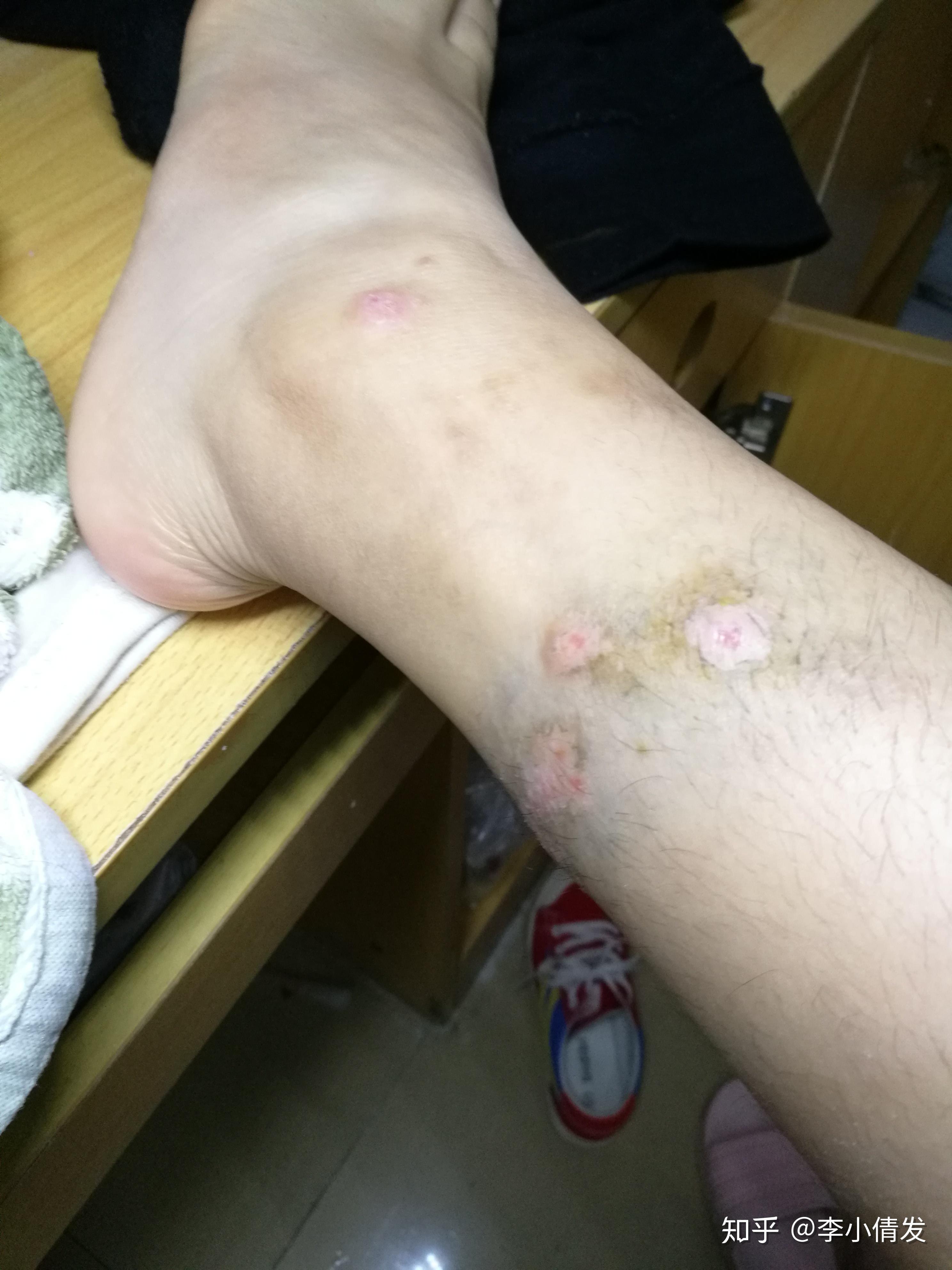 成人湿疹 - 知乎