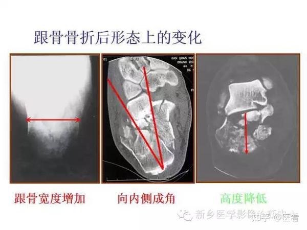 【分型】跟骨骨折的分型与图解 - 知乎