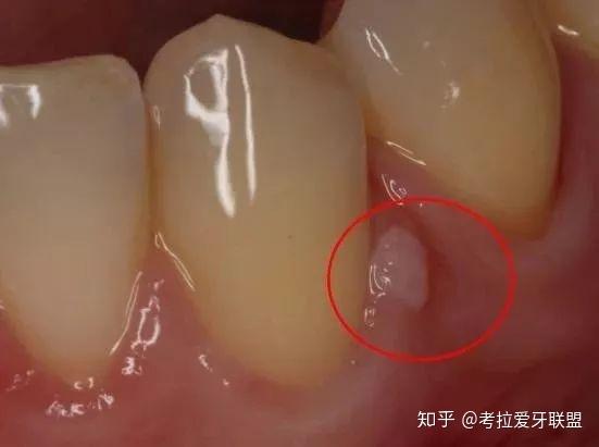 牙龈上长了脓包 可以挑破吗 知乎