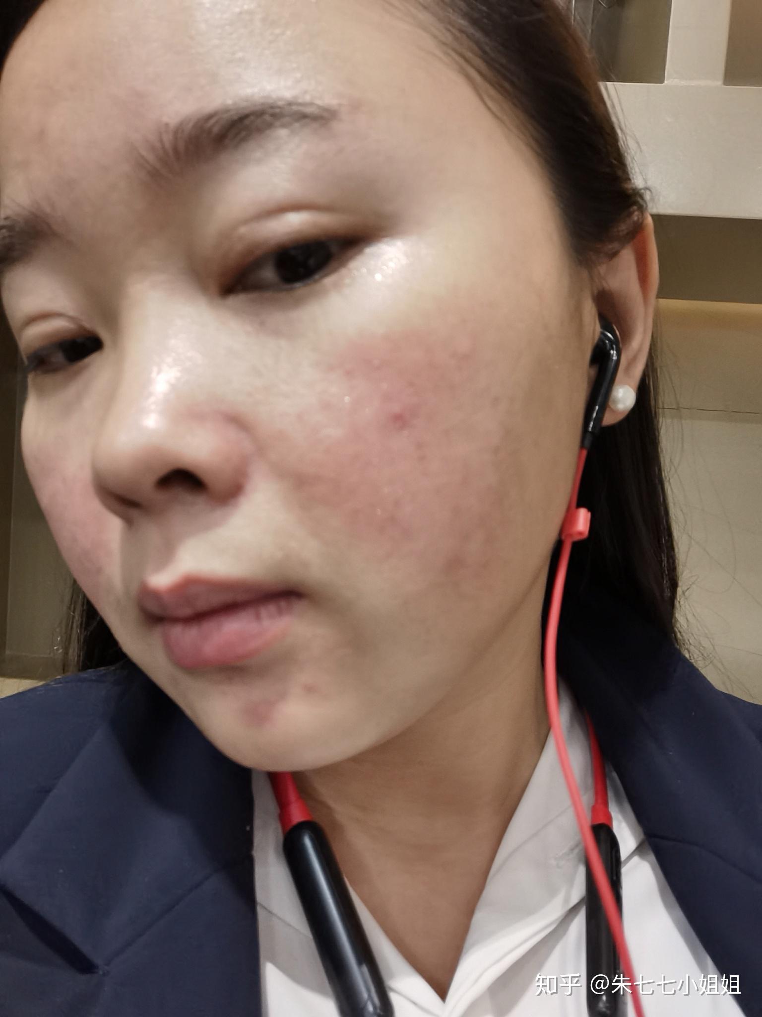 自己在家做微针第三天晚上