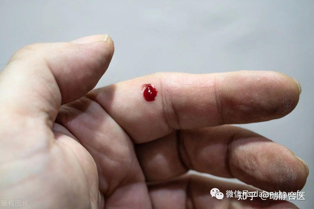 中医放血疗法为什么有效,实践+理论经验是这么告诉我的 - 知乎