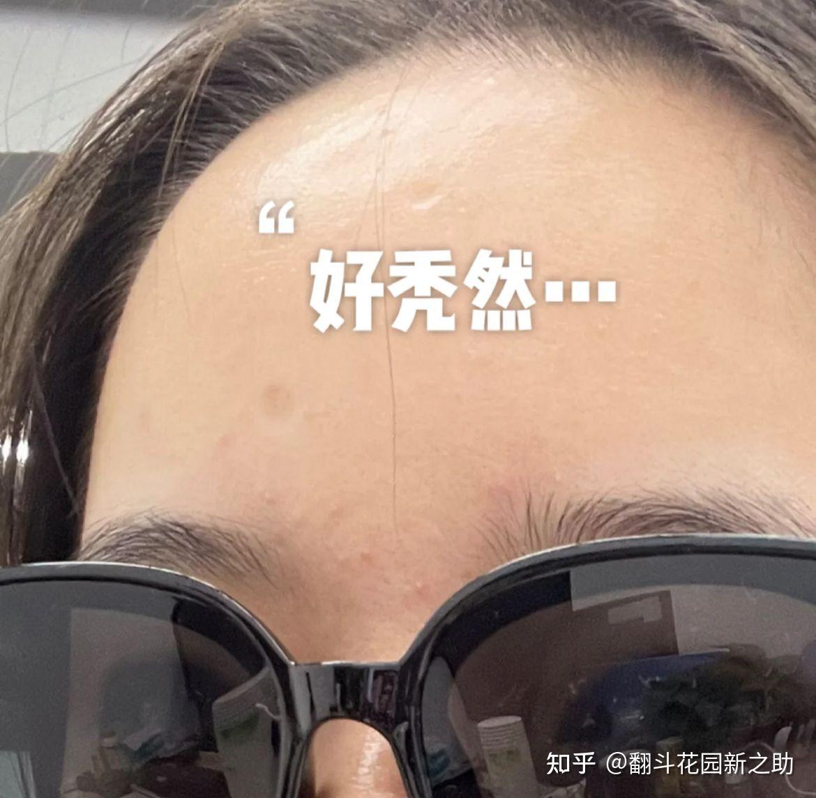 不留刘海的话发际线又是这样的:用我那缺德姐妹的话来说:"cmg你怎么