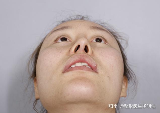 鼻子做歪了如何修复止损