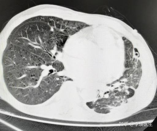 感染真菌性肺炎每天失血500ml生命垂危如何一个月起死回生