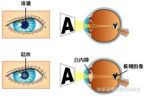 白内障手术是怎么做的 白内障手术复杂吗 知乎