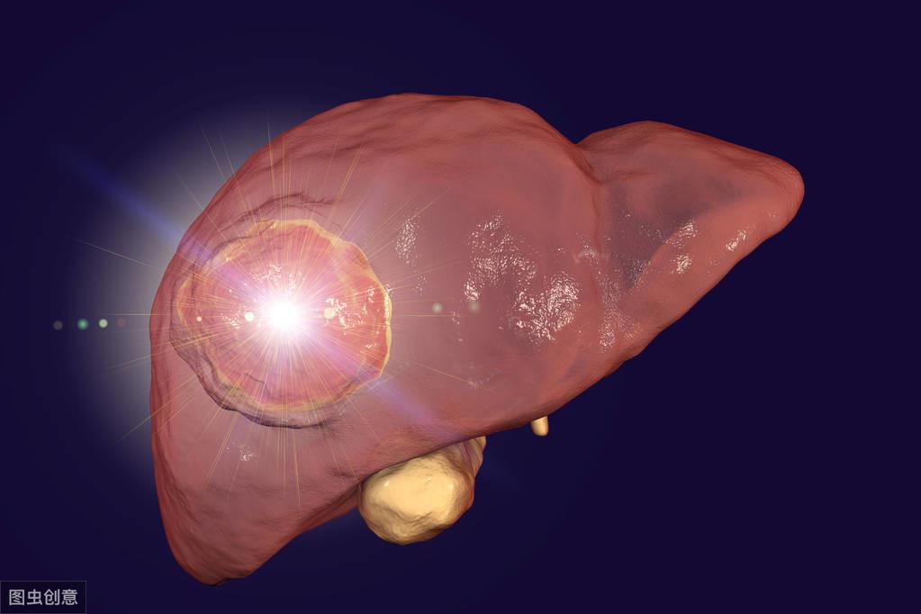 巨大肝血管瘤怎么办?——介入栓塞轻松来解决!