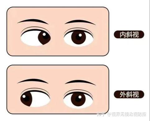 斜视是遗传？不要忽视以下这些斜视因素 - 知乎