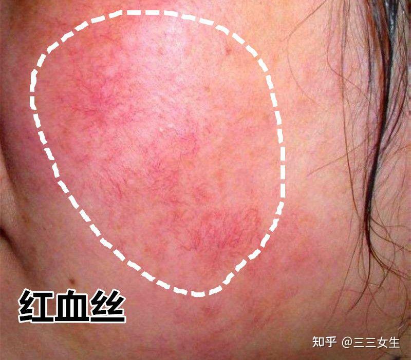 角质层薄有红血丝皮肤可以自己修复吗
