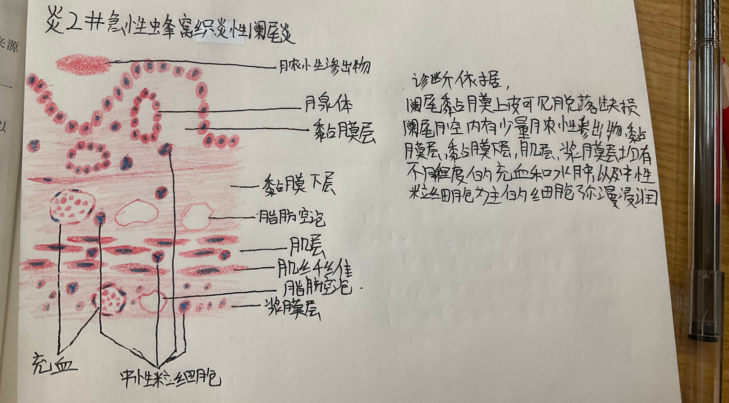 急性蜂窝织炎性阑尾炎假膜性炎镜下红蓝铅笔手绘图