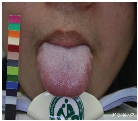 代谢综合征患者出现的厚白苔   来源:10.1155/2016/1971295