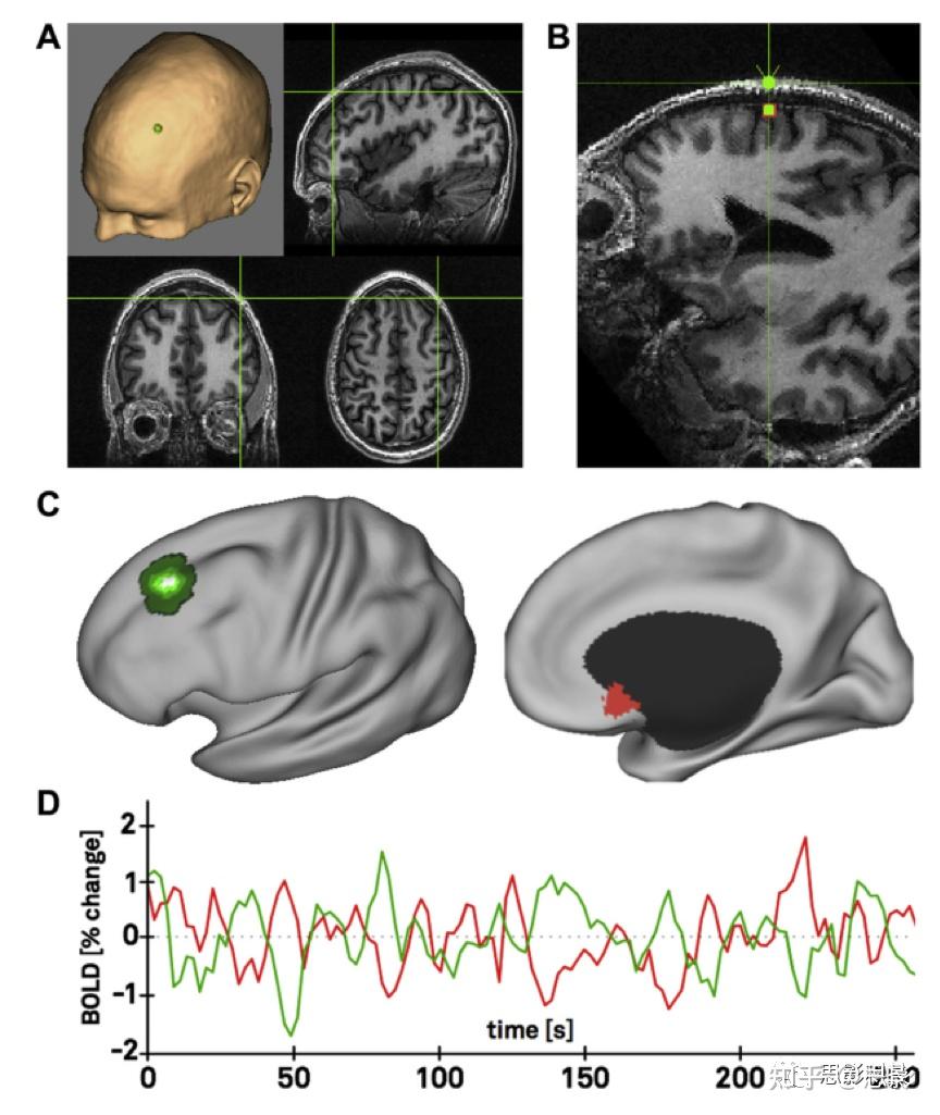 biologicalpsychiatry亚属连接预测经颅磁刺激位点抗抑郁疗效