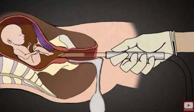 帮人堕胎1200次后他开始强烈反堕胎原因太恐怖