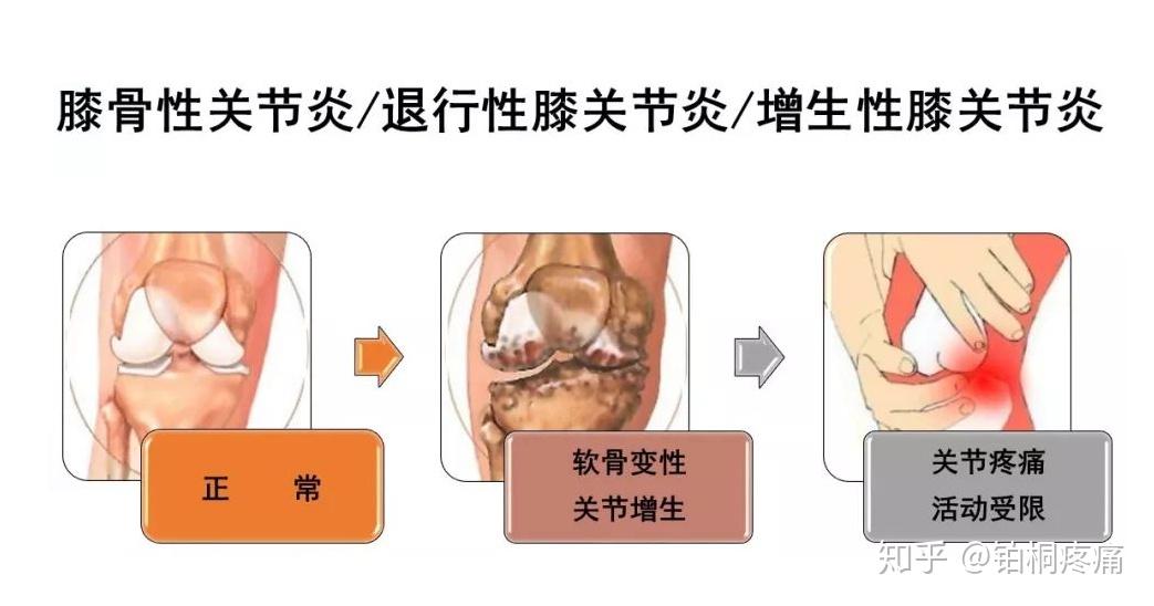 寒冷冬季是关节炎的高发季节应如何保护膝关节