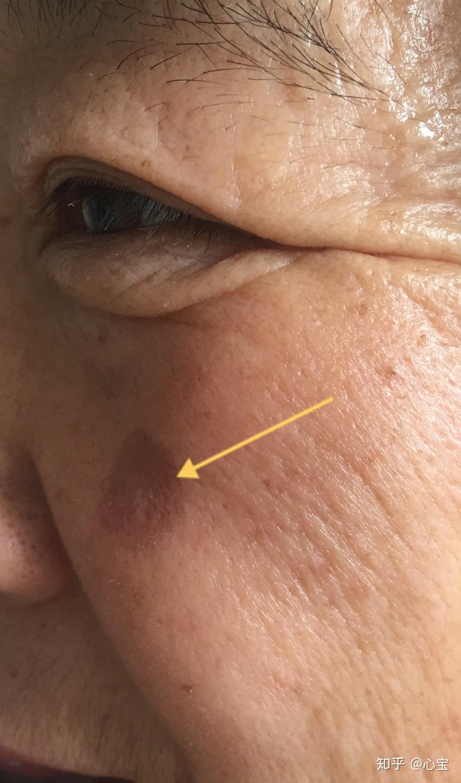 请问这是什么斑