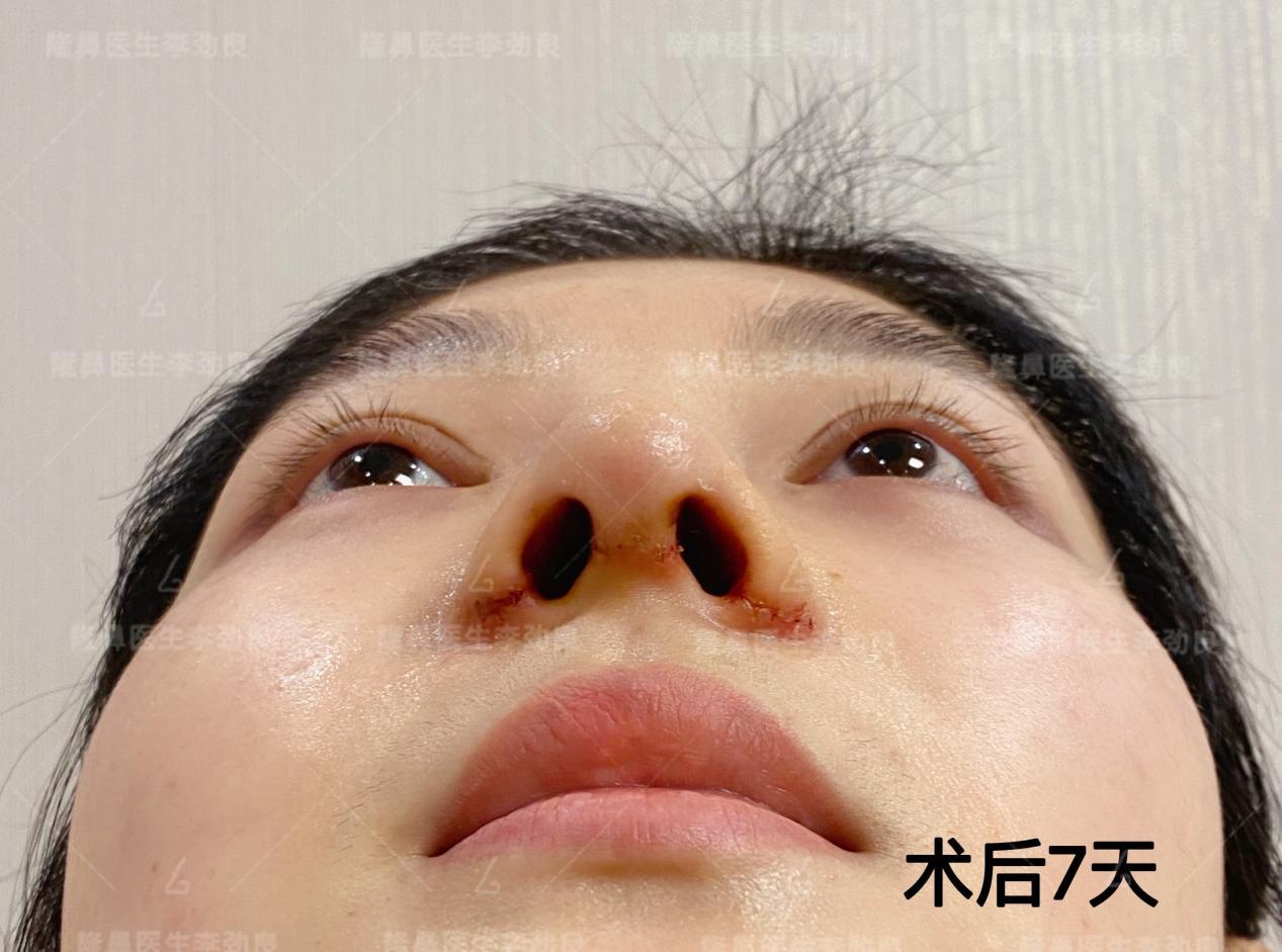 【鼻翼内外缩小+鼻槛、鼻翼脚上提+鼻翼疤痕切除】-杨杰-爱问医生
