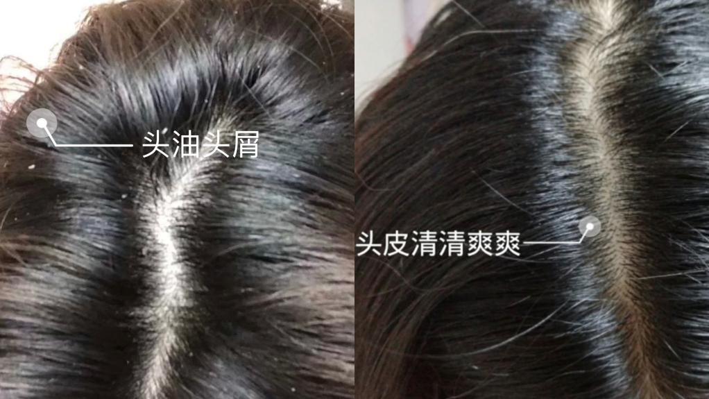 【秃子乐】防脱发+秃头自救,选对防脱发洗发水,绒毛疯狂生长! - 知乎