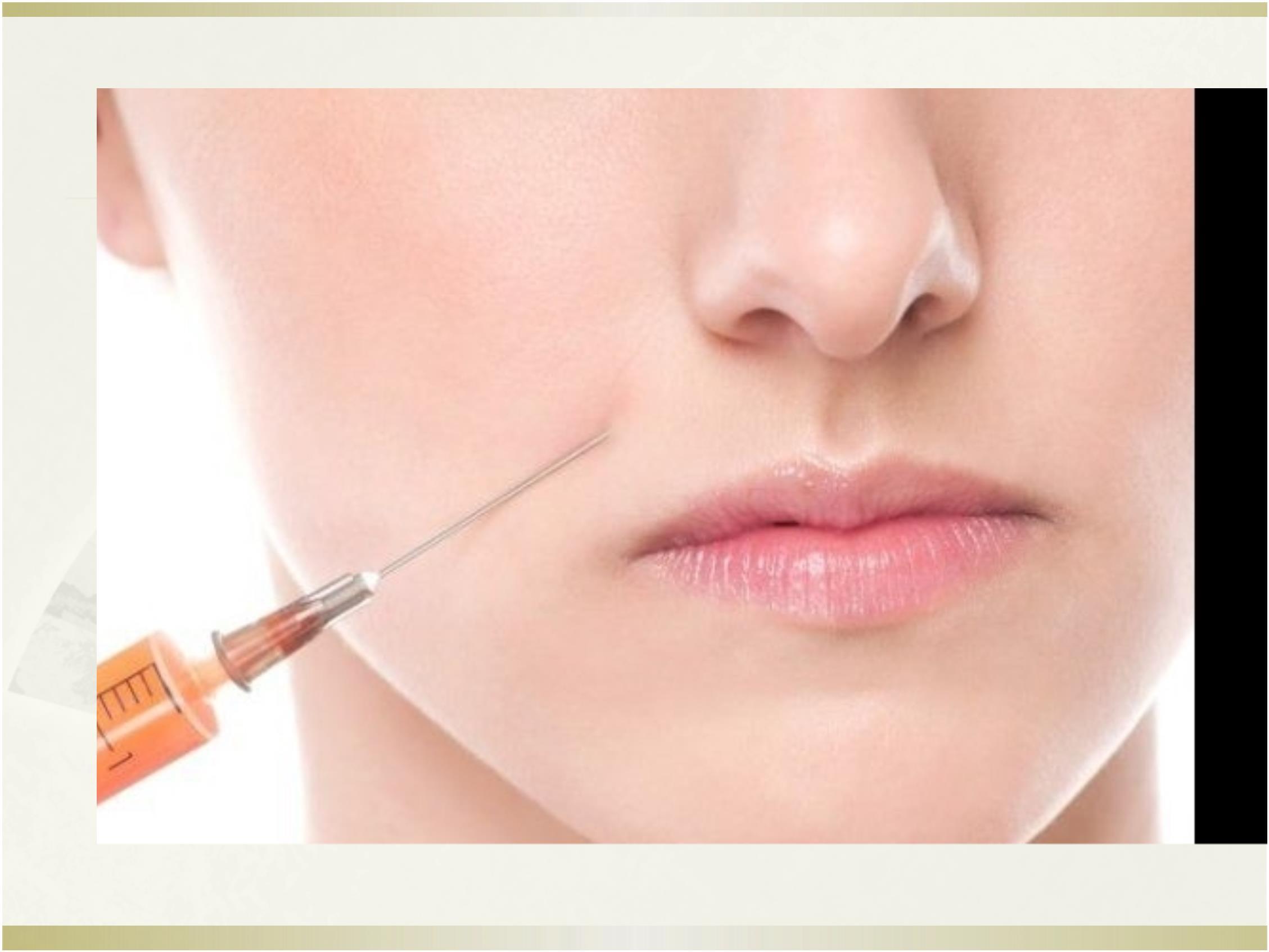 鞍鼻整形一个让人羡慕的鼻子