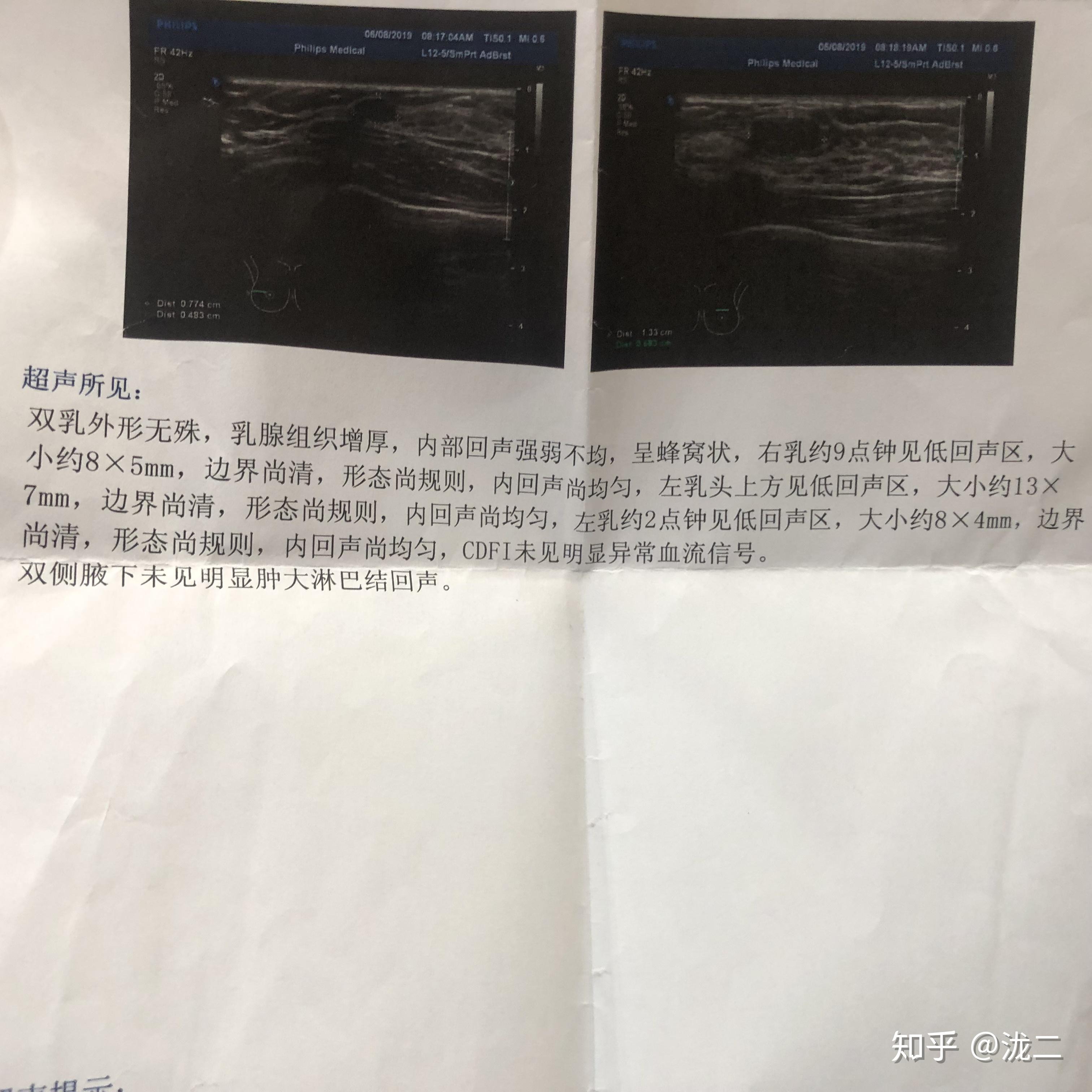 記錄乳腺纖維瘤微創手術