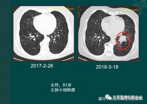 小细胞癌肺癌图片