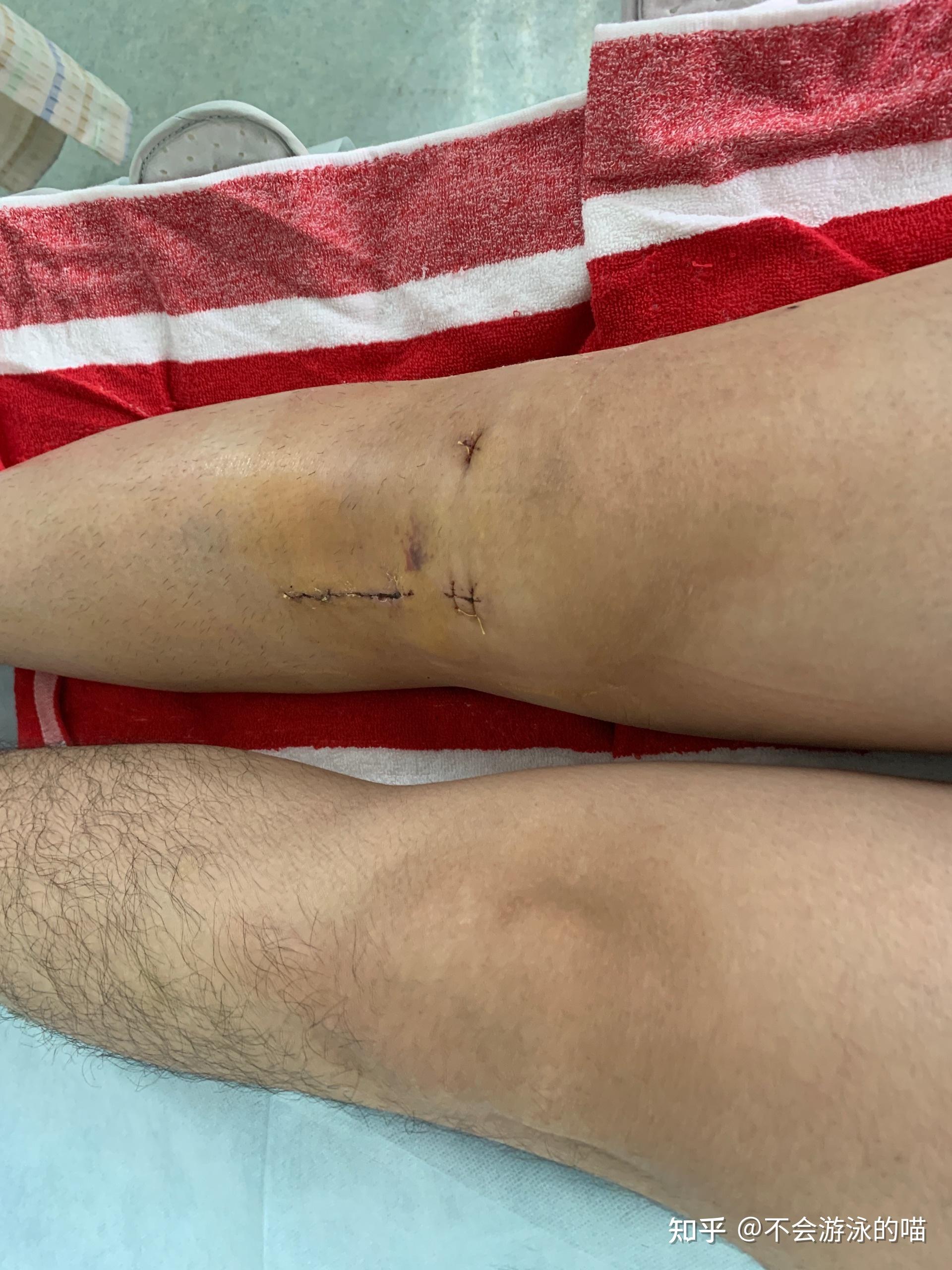 我的前交叉韧带重建手术及康复经历 - 知乎