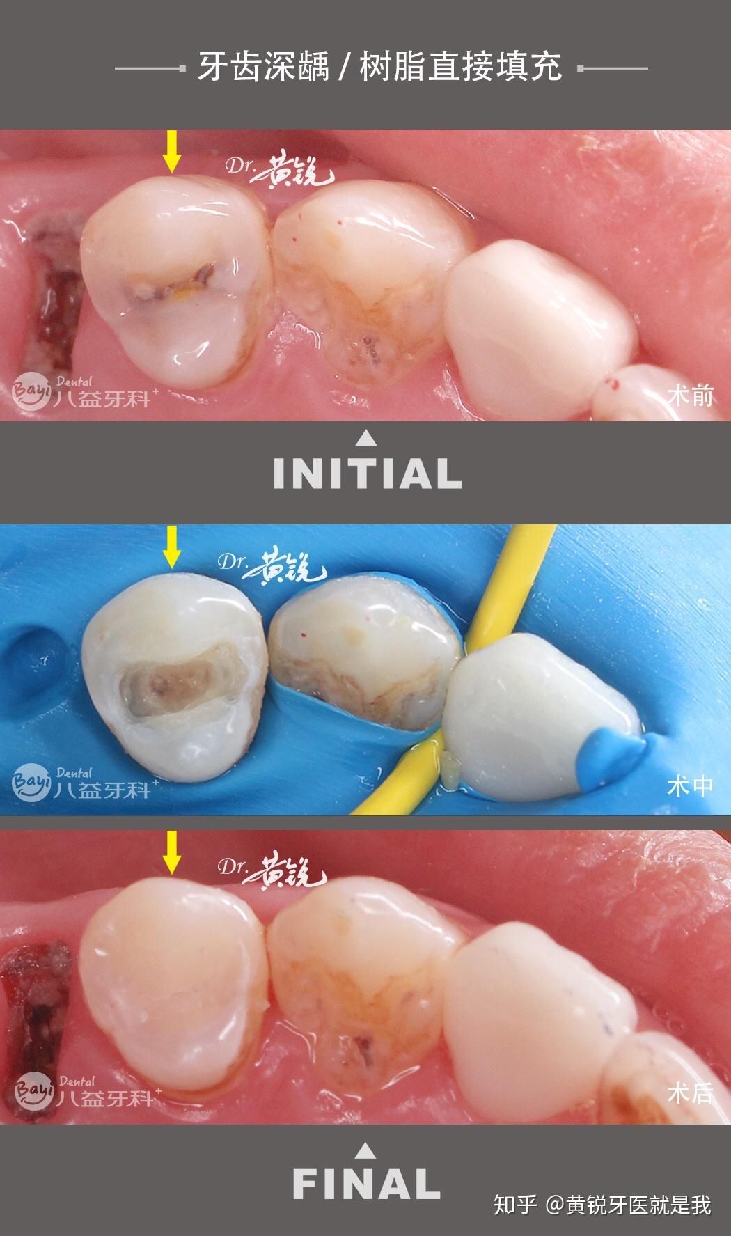牙齿大面积缺损/髓腔固位冠修复 - 知乎