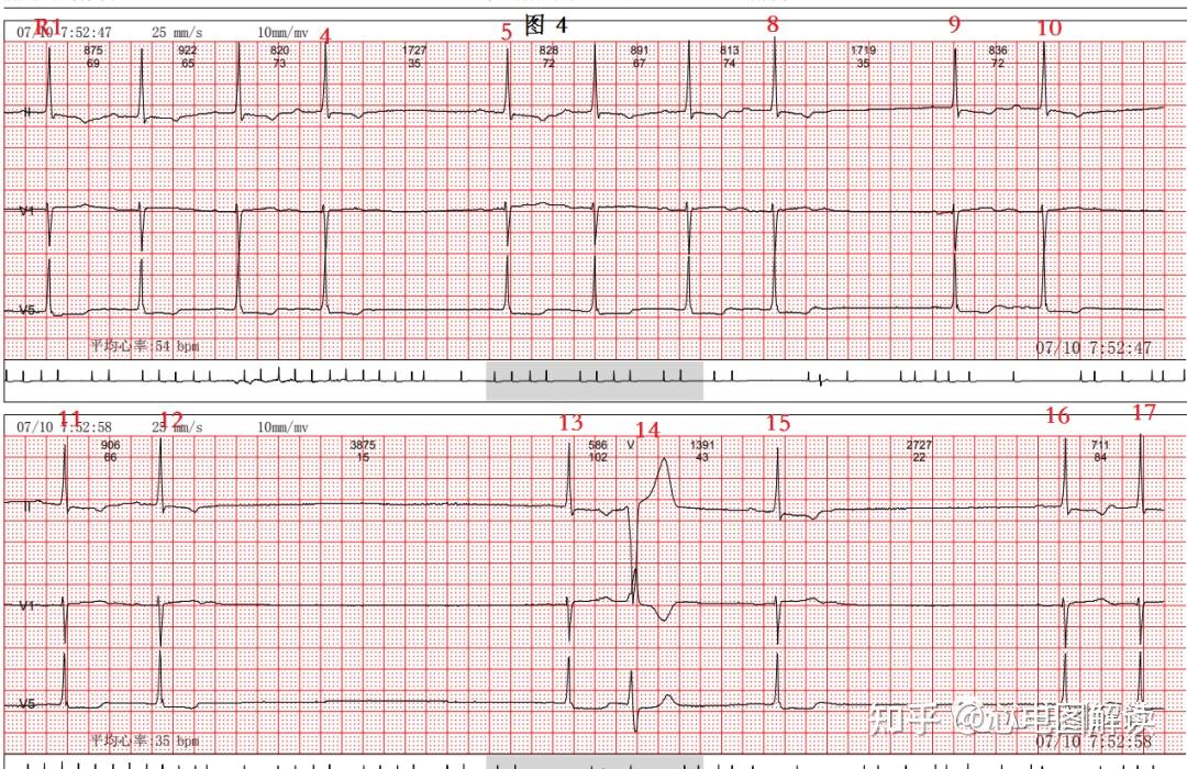 心脏漏搏的心电图图片