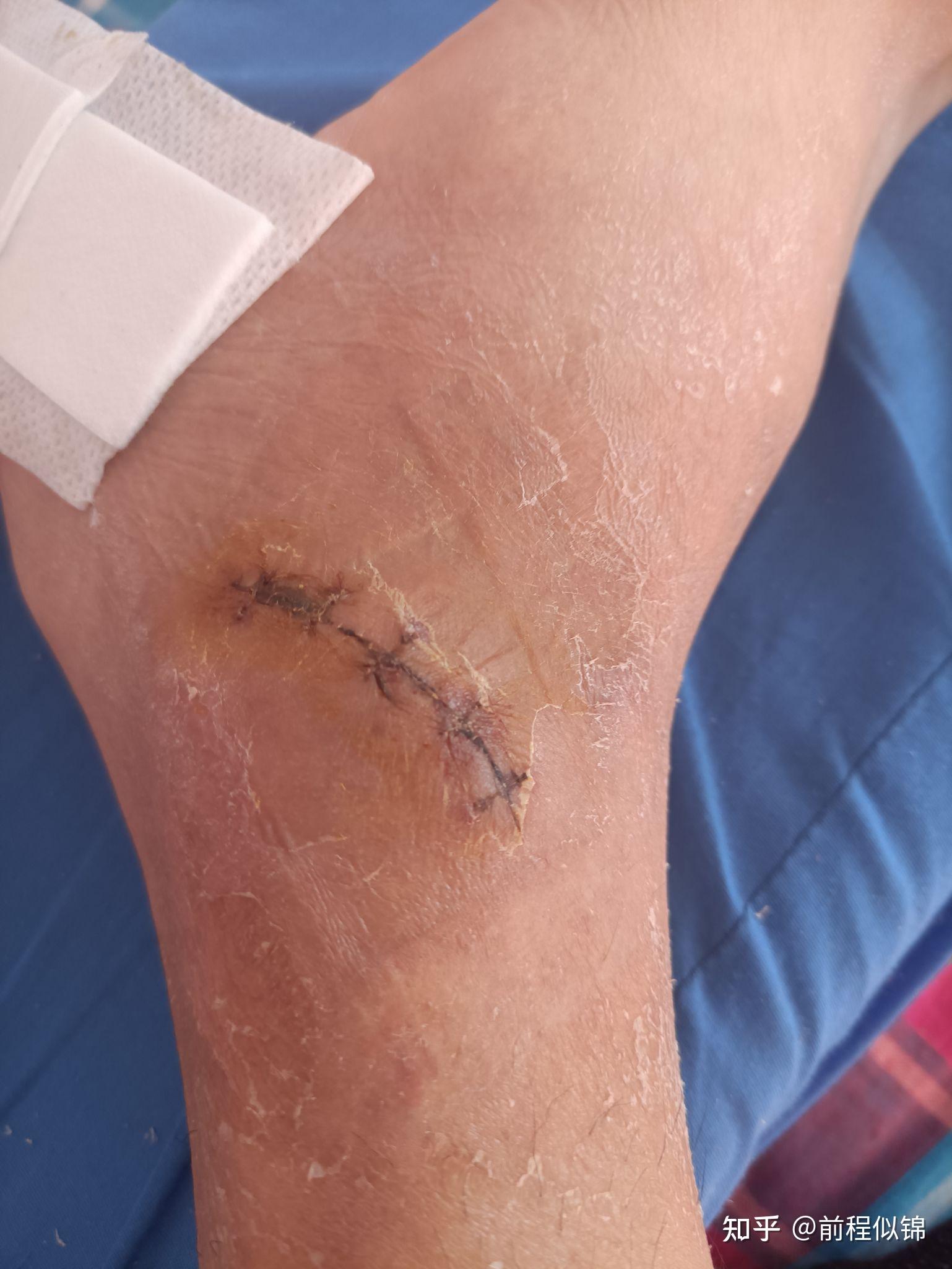 脚踝韧带损伤记录