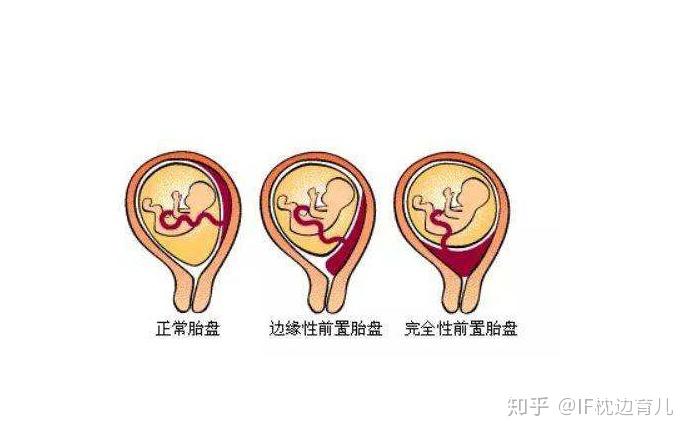 剖宫产一年以后怀孕,需要注意什么?想顺产得“三看” - 知乎
