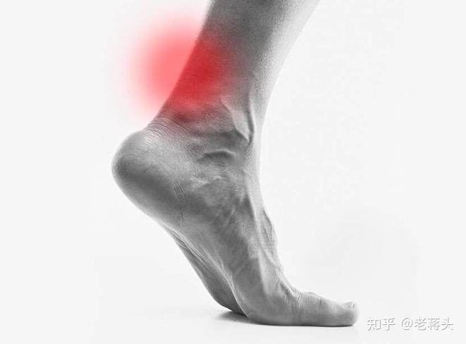 "阿基里斯腱"之痛——跟腱炎