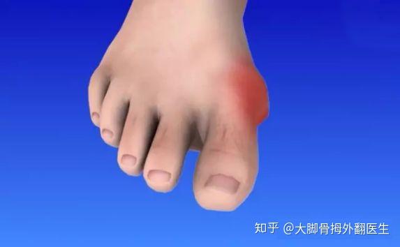大脚骨也叫拇外翻,是指脚拇指向外偏斜超过正常角度,很多女性都患有大