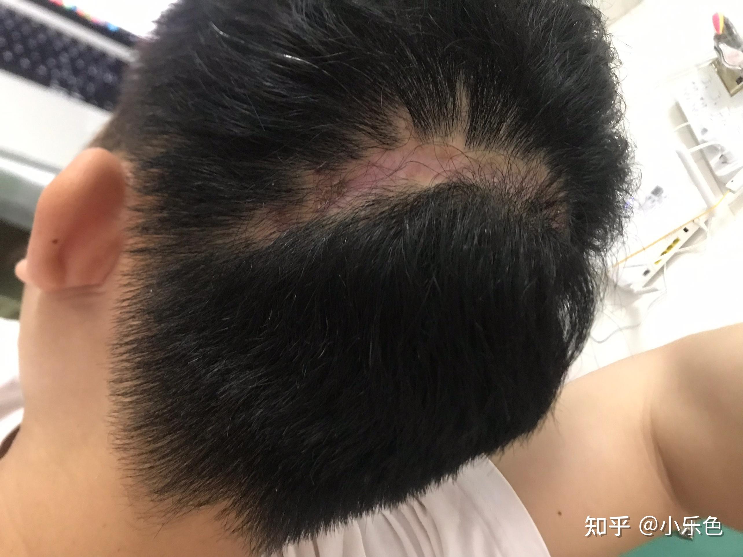 皮脂腺痣再见经历过一次死亡人活着就是找罪受