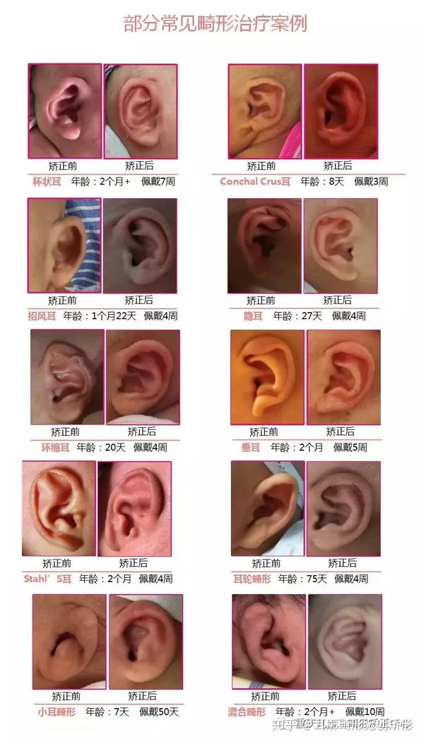 耳朵类型分类图片大全图片