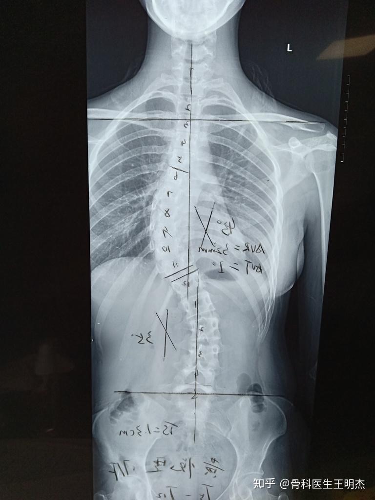 脊柱側彎是指站立位時應用cobb角法測量x線平片上脊柱側方彎曲的角度
