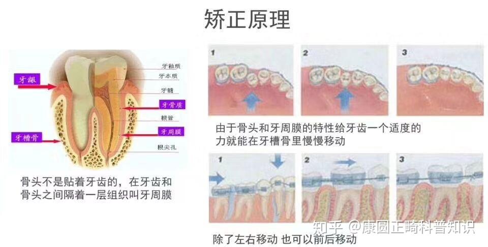 正畸牙齿移动的原理_正畸中牙齿移动的原理(3)