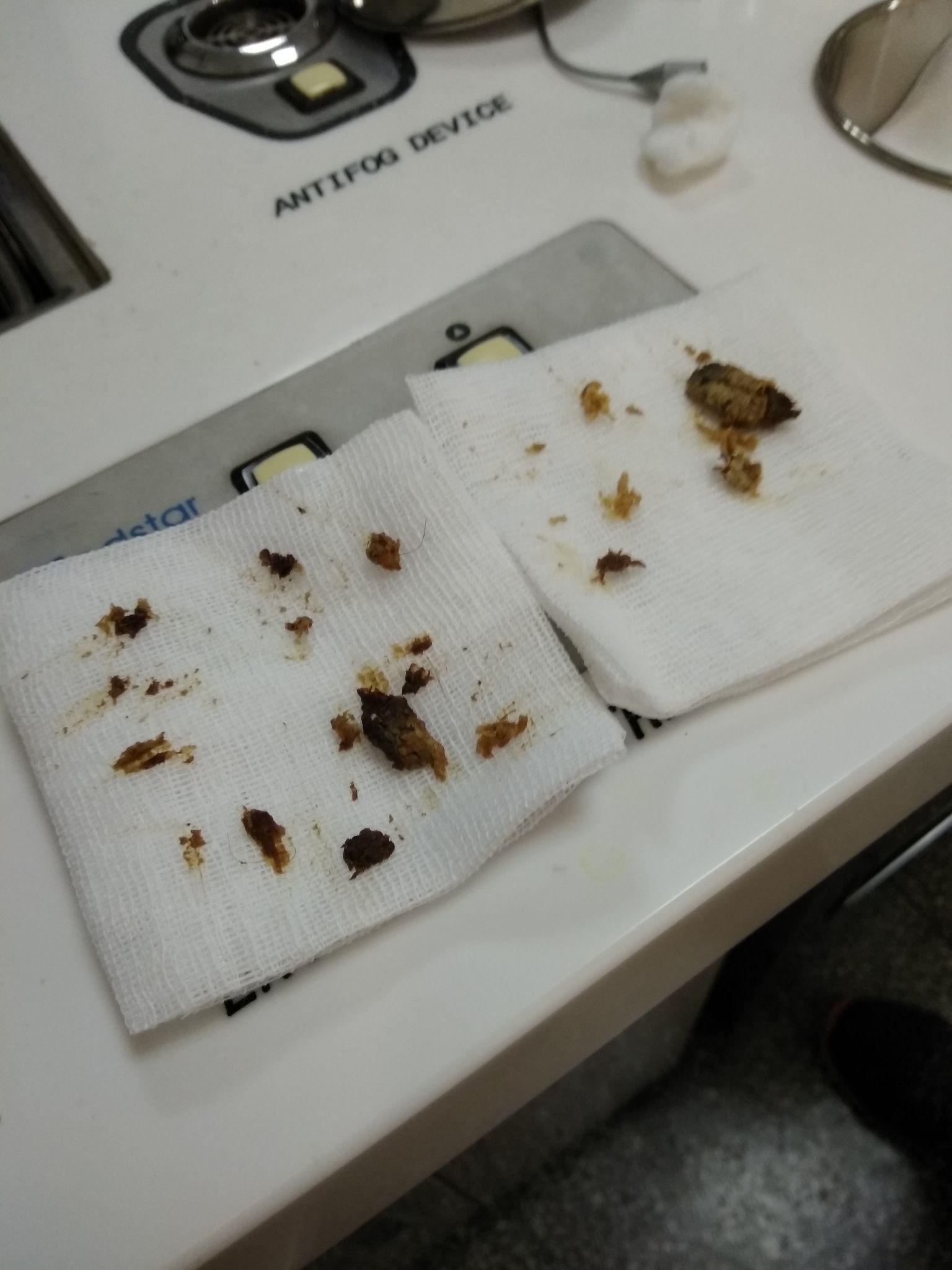 又去看.结果.医生说是耳屎堵的发炎了?