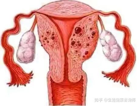 什么是子宫平滑肌肌瘤 v2-5f631d8fe02a83c3ef103bfd694691c5_r.jpg