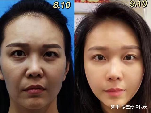 能维持多久?多少钱一针?抗衰必看(建议收藏)!