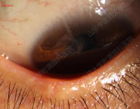 吓人眼睛里长出了巨大的结石原因竟是