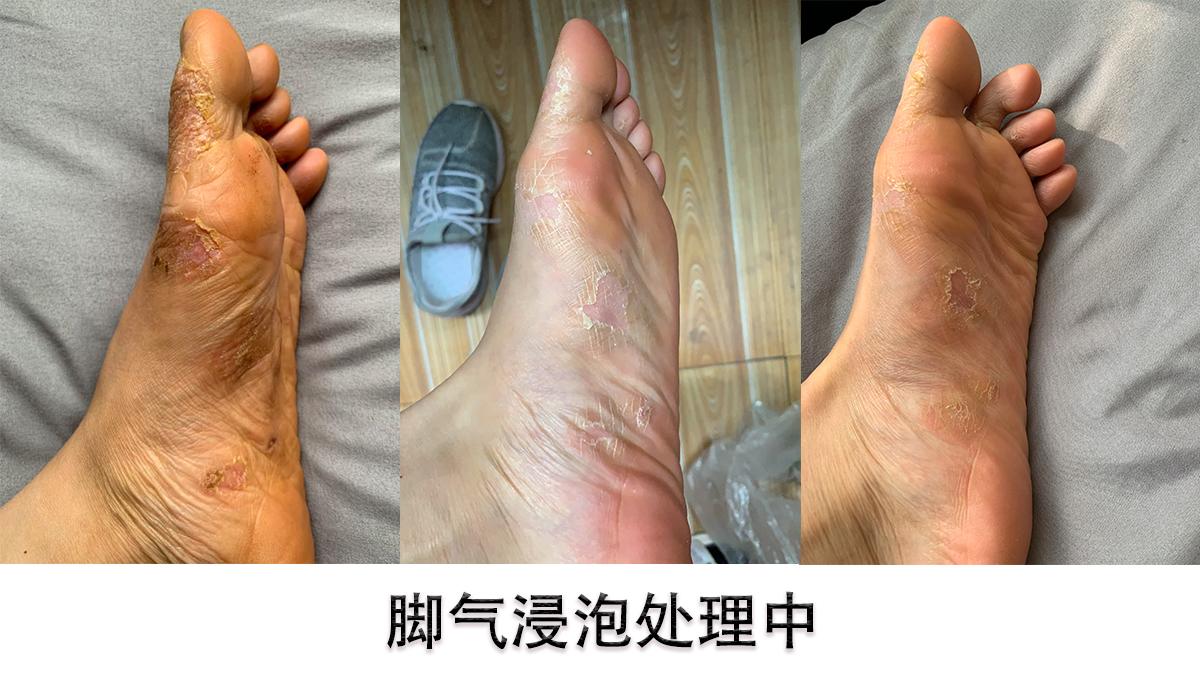 鸡皮肤就是脚气吗(脚上的鸡皮肤是怎么形成的)