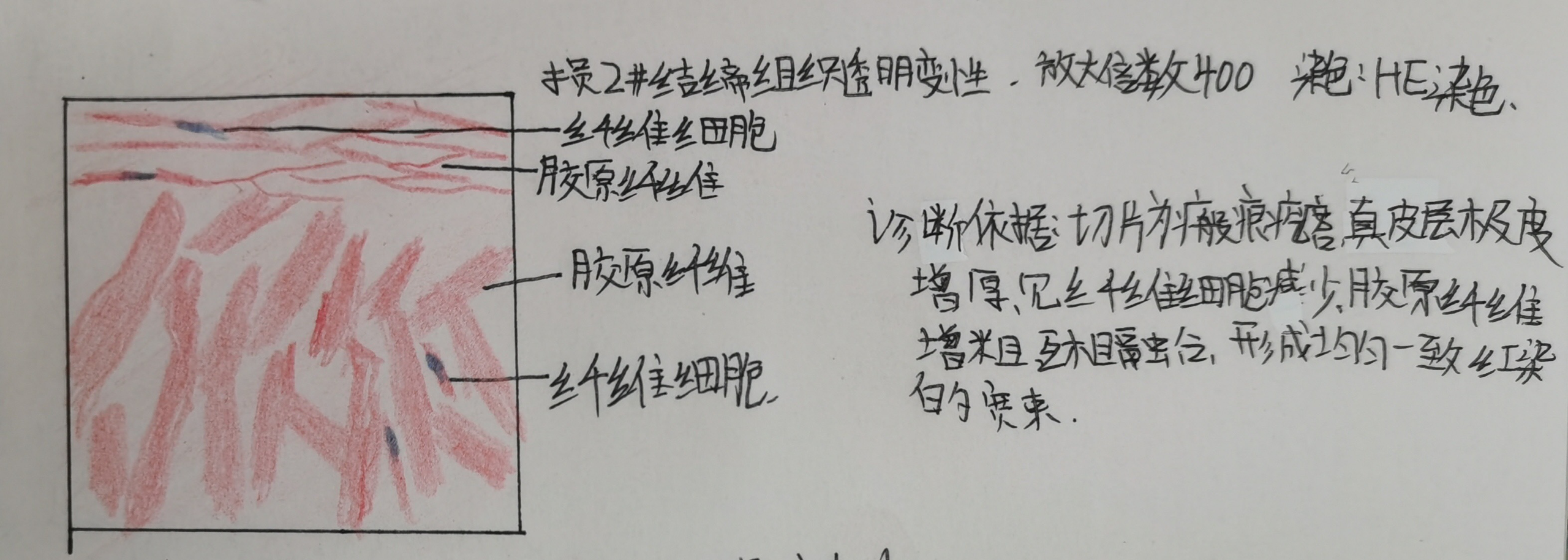 结缔组织透明变性肉芽组织肾小管上皮细胞颗粒变性肾水肿镜下红蓝铅笔