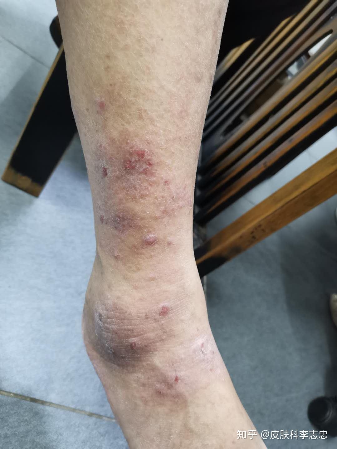 慢性湿疹,皮肤瘙痒难耐怎么办? - 知乎